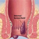 Disqus profile picture for @hemorrhoids
